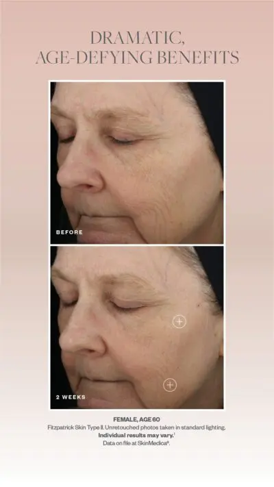 SkinMedica TNS antes y después