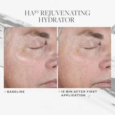 SkinMedica HA5 Hidratante Rejuvenecedor Antes y Después