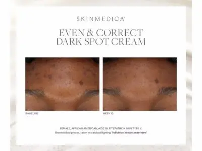Fotos de antes y después de la crema para manchas oscuras Even & Correct de SkinMedica