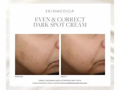 SkinMedica Even and Correct Dark Spot Cream Fotos de antes y después