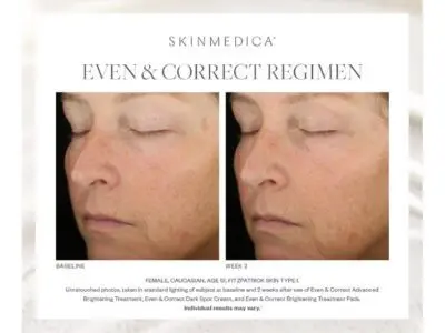 SkinMedica Even y Correct Pads Fotos de antes y después