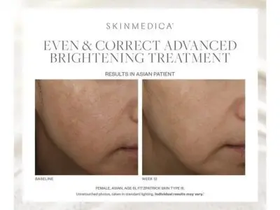 Fotos de antes y después del tratamiento uniforme y correcto de Skin Medica