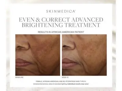 Fotos de antes y después del tratamiento uniforme y correcto de SkinMedica