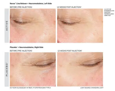 Revox-Line-Relaxer-eyes before and after