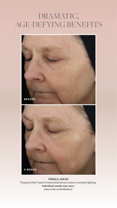 SkinMedica TNS Before and After
