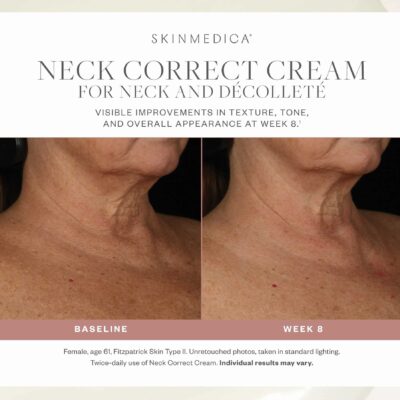 SkinMedica Neck Correct Cream Before After
