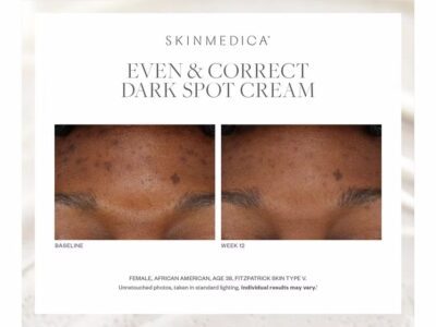 SkinMedica Even & Correct Dark Spot Cream Before & After Photos