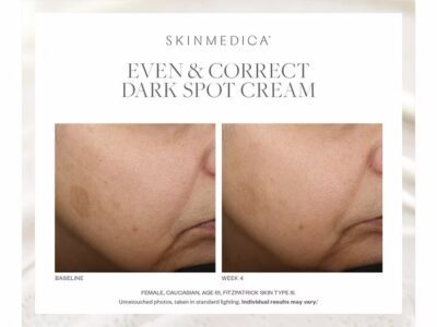 SkinMedica Even and Correct Dark Spot Cream Before & After Photos