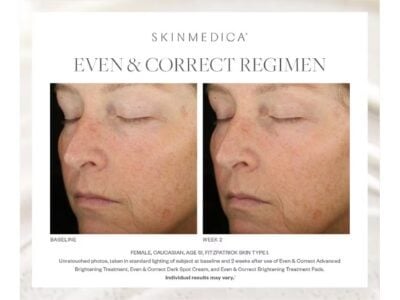 SkinMedica Even and Correct Pads Before & After Photos