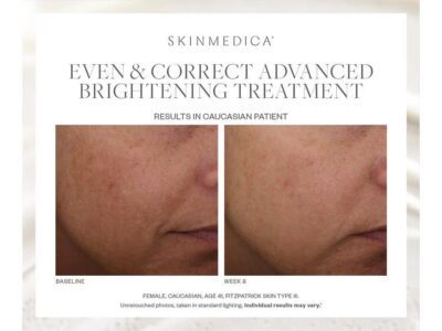 SkinMedica Even & Correct Treatment Before & After Photos