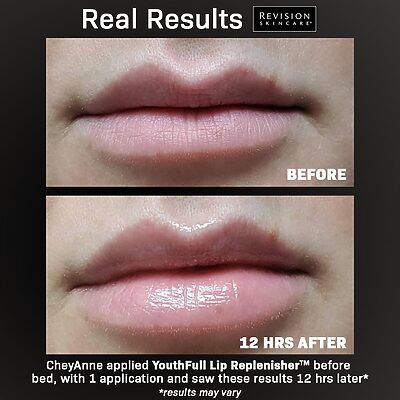Revision youthfull Lip Replenisher Results Before & After