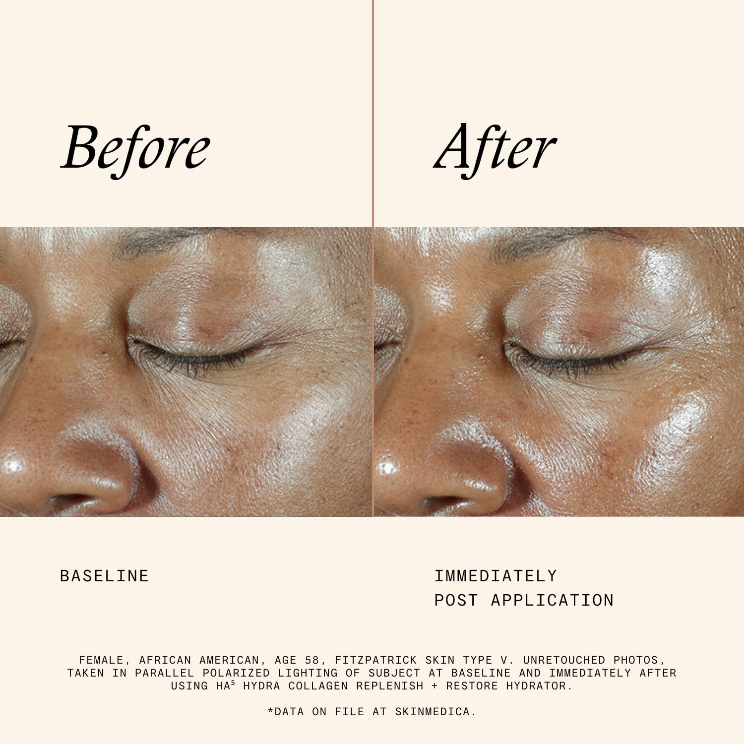 SkinMedica HA5 Hydra Collagen Hydrator before and after