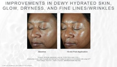 skinmedica ha5 replenish restore hydrator before after hydrated