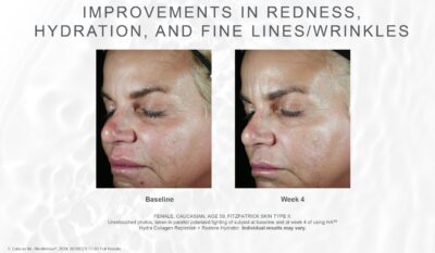 skinmedica ha5 replenish restore hydrator before after hydration