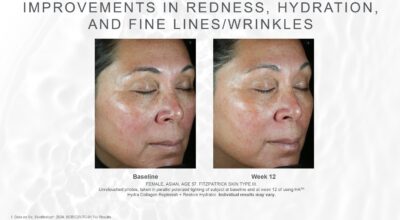 skinmedica ha5 replenish restore hydrator before after redness