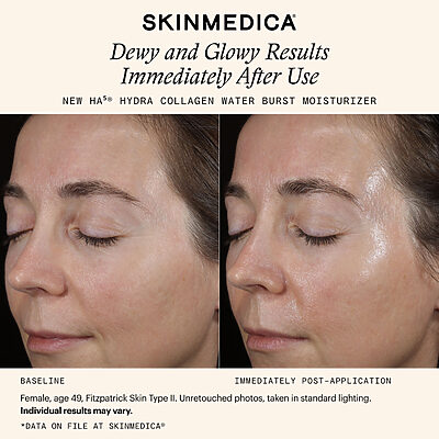 SkinMedica HA5 Hydra Collagen Moisturizer Before & After Results-1