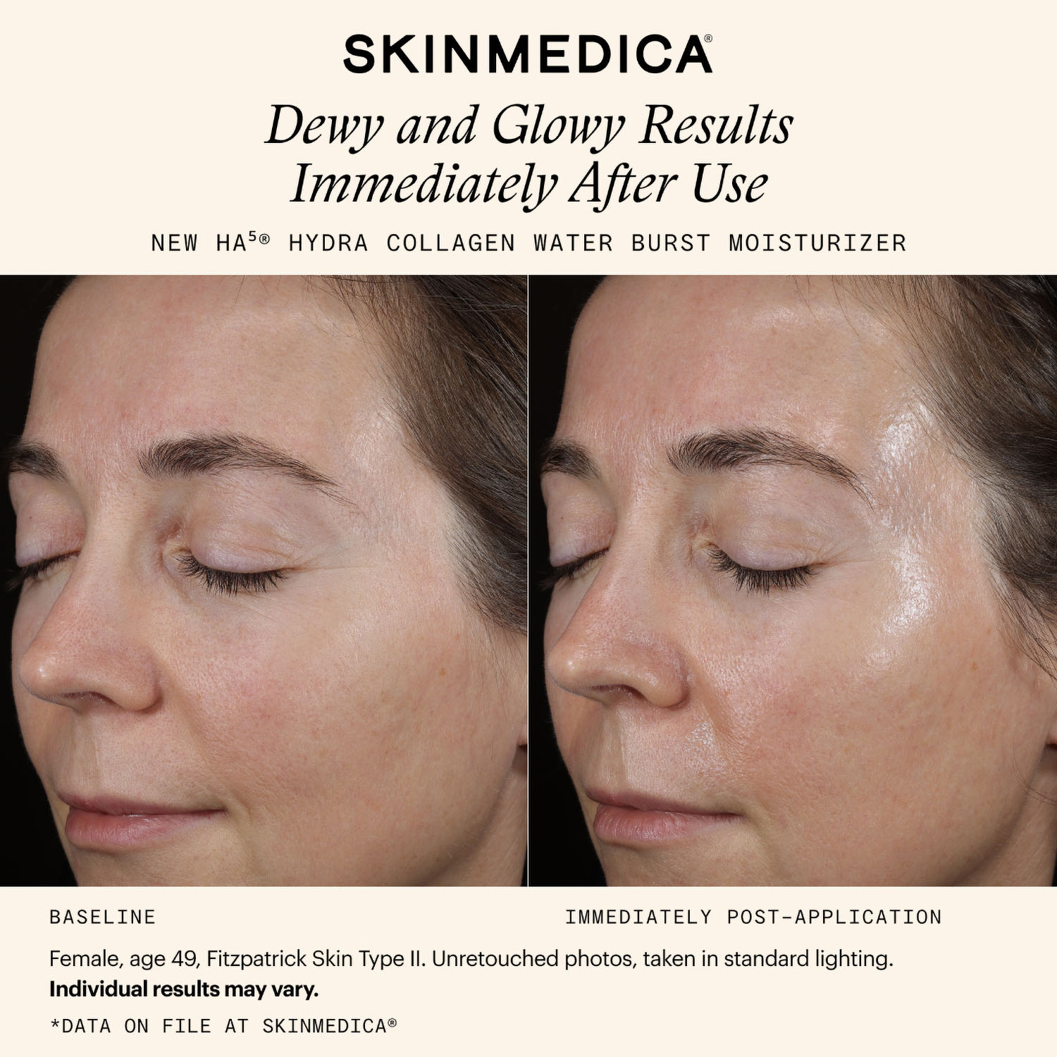 SkinMedica HA5 Hydra Collagen Moisturizer Before & After Results-1