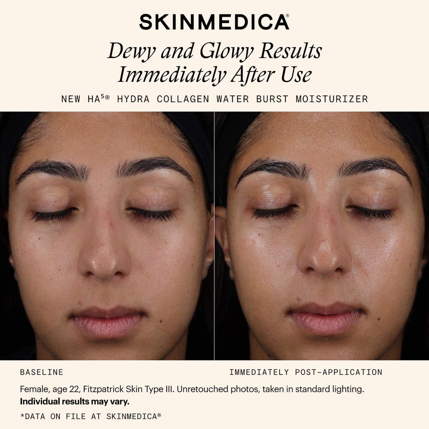 SkinMedica HA5 Hydra Collagen Moisturizer Before After Results