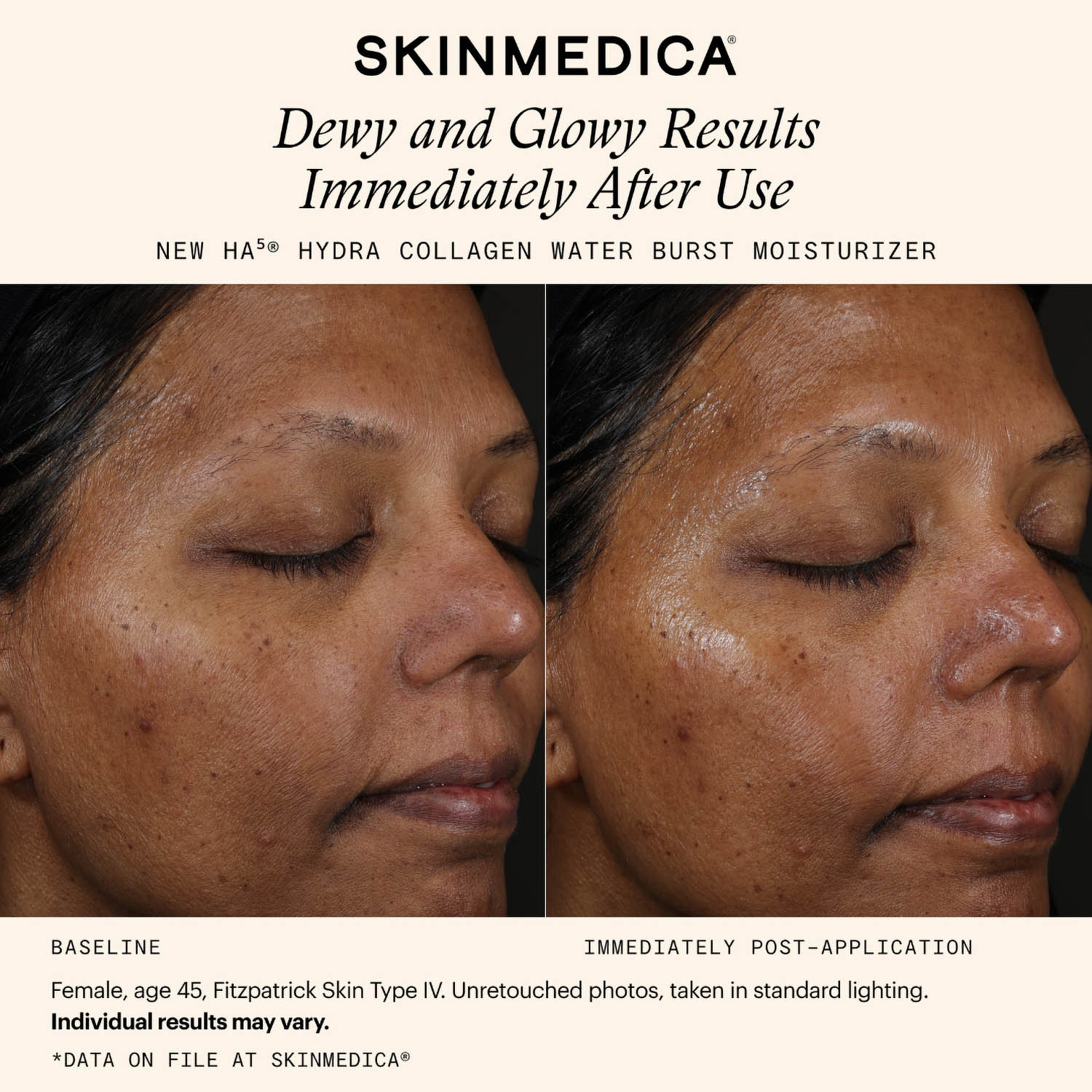 SkinMedica HA5 Hydra Collagen Moisturizer Before After