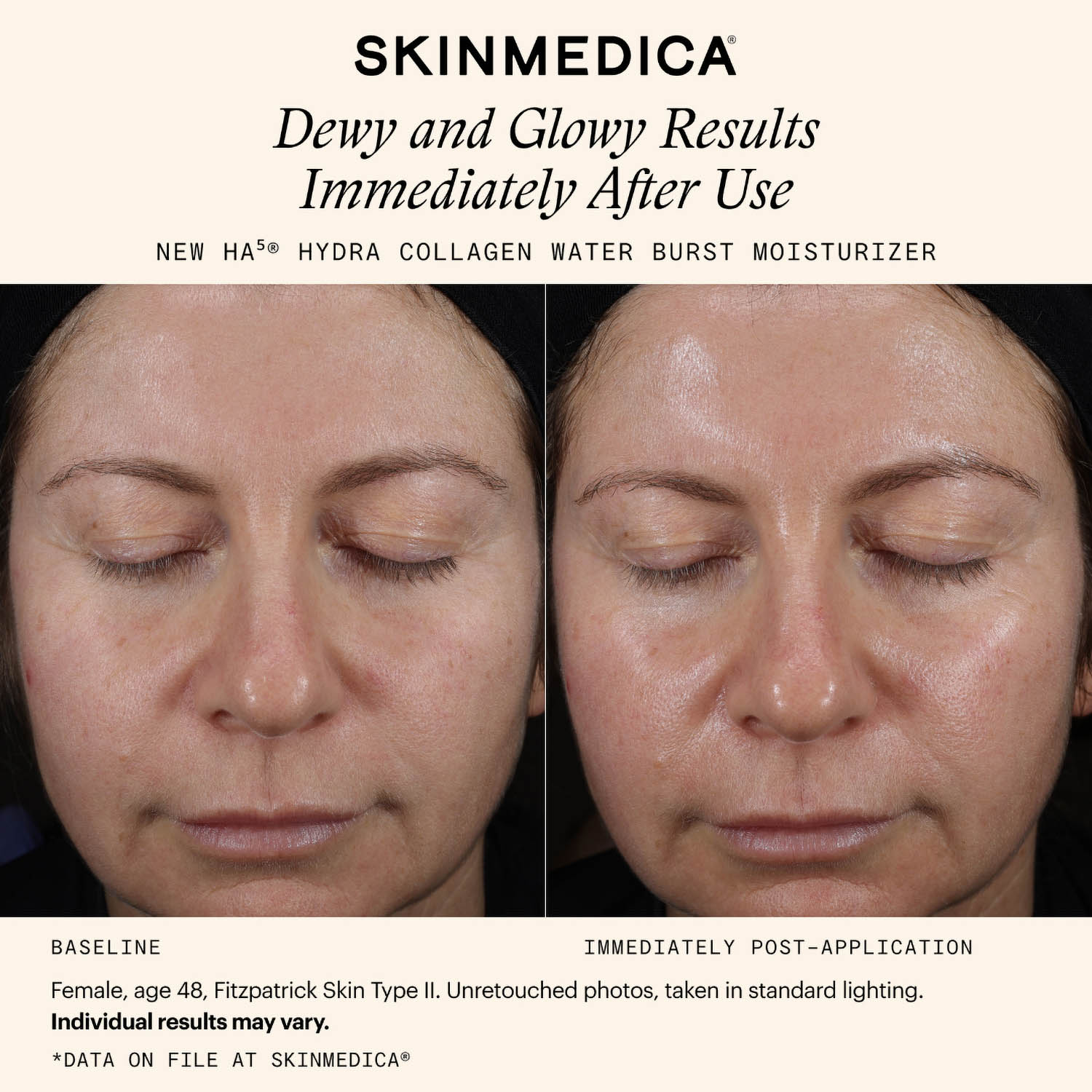 SkinMedica HA5 Hydra Collagen Moisturizer Before and After