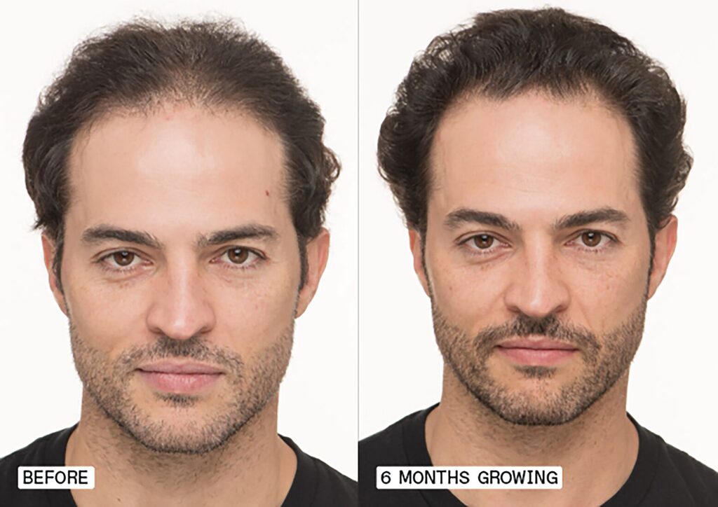 Nutrafol for Men 50+ Before & After